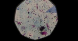 Preocupa una bacteria cuyo contagio no para de crecer y causa una muerte cada siete horas pese a tener cura