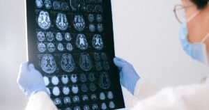 Exitosa prueba en humanos para evitar el Alzheimer con un método que fortalece el sistema inmune del cerebro