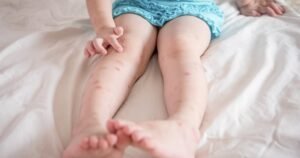 Advierten por un hábito que potenció la pandemia y eleva el riesgo de que los niños desarrollen alergias